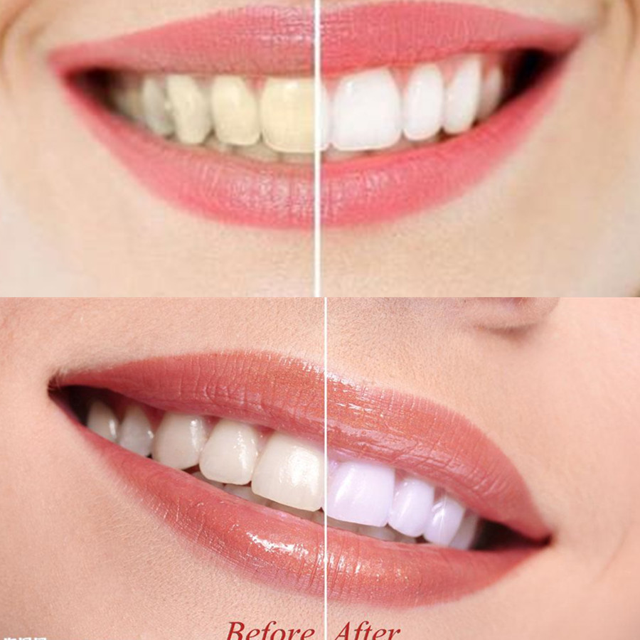 Bamboo Charcoal Teeth Tooth De - Teeth Whitening Singapore 리뷰 및 가격