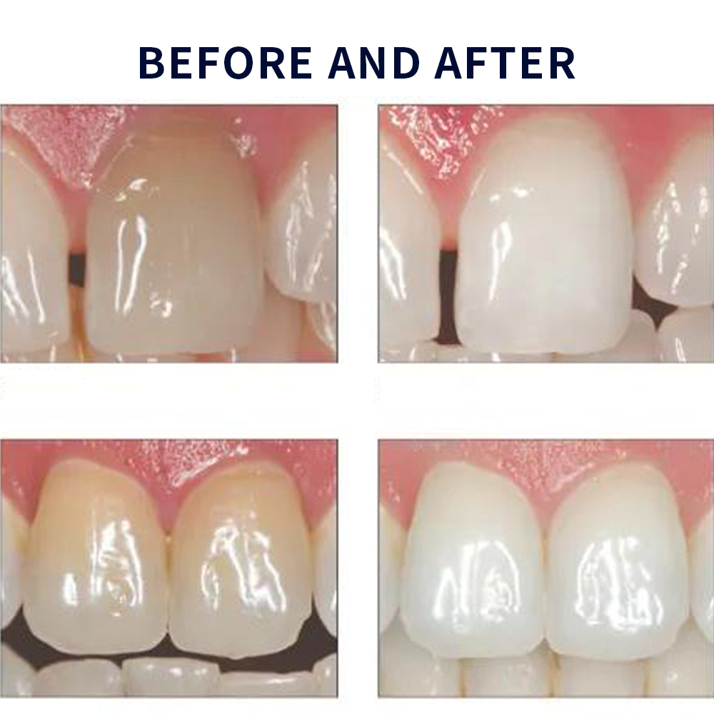 Opalescence Whitening 20% PF 2 - Teeth Whitening Singapore 리뷰 및 가격