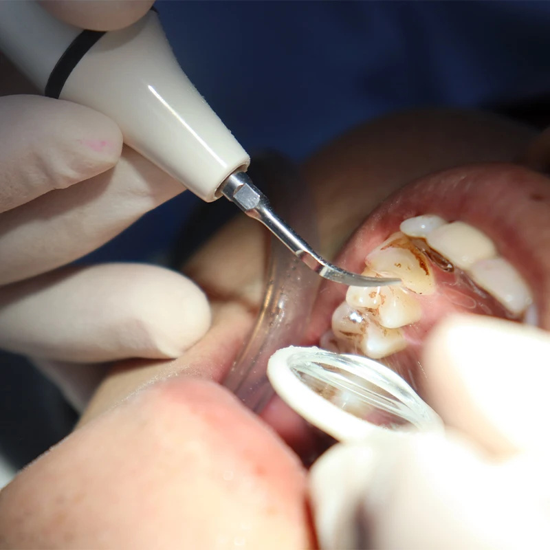 Scaler Handpiece Tube Cable fo - Teeth Whitening Youtube 리뷰 및 가격