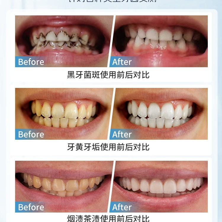 Japan Manual Tooth Stain Remov - Teeth Whitening Japan 리뷰 및 가격